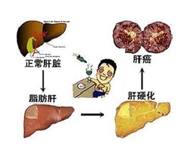 肝病在早期没有明显症状此外,脂肪肝还可损害消化系统功能,降低人体