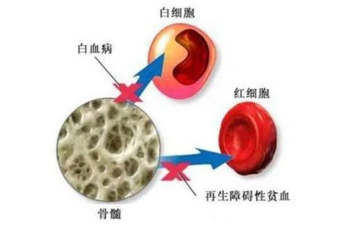 再障没治好就会变成白血病吗?_腾讯新闻