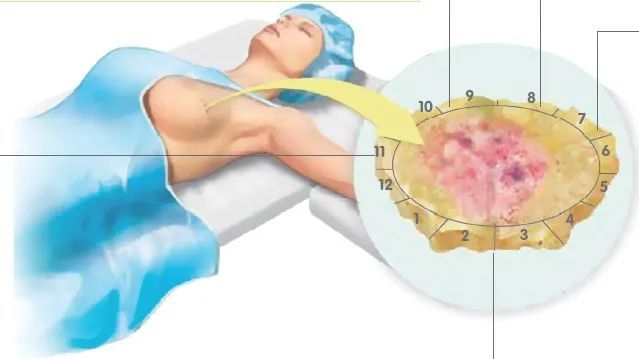 健康女性可以切除双侧乳房(健康女性可以切除双侧乳房吗)-第1张图片-鲸幼网