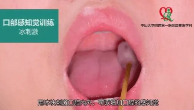 3)冰刺激:用冰块或冰棉签刺激舌头,腭弓,咽后壁;2)喉部按摩:左右按摩