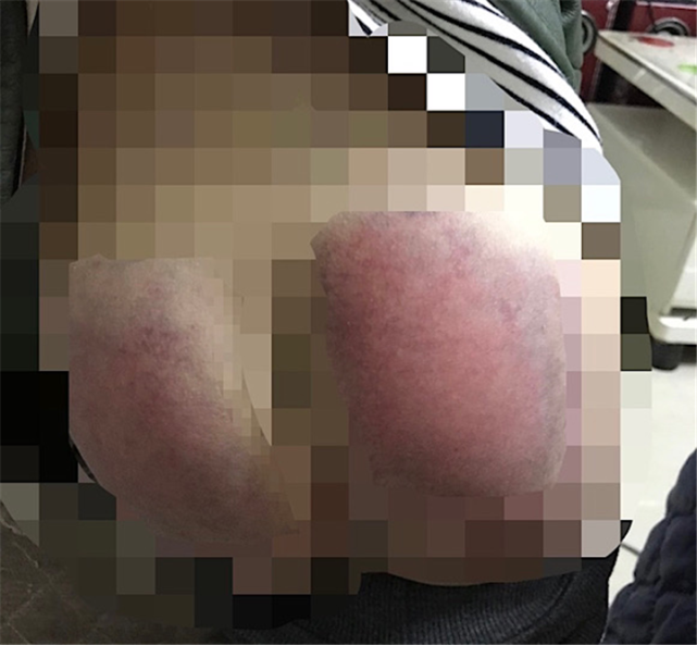 6岁女孩未完成作业被老师打板子住院老师她不哭我以为不痛