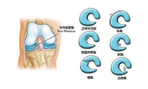 膝蓋充血腫脹請鑑別診斷滑膜炎和半月板損傷