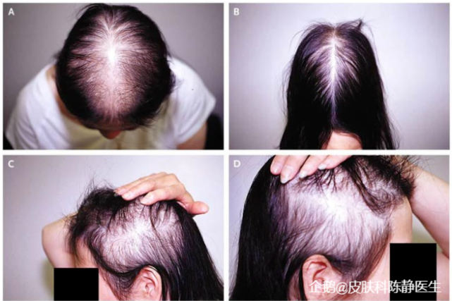 发际线最终形成特征性的 m"形,头顶的头发也逐渐稀疏,最终发展成秃头