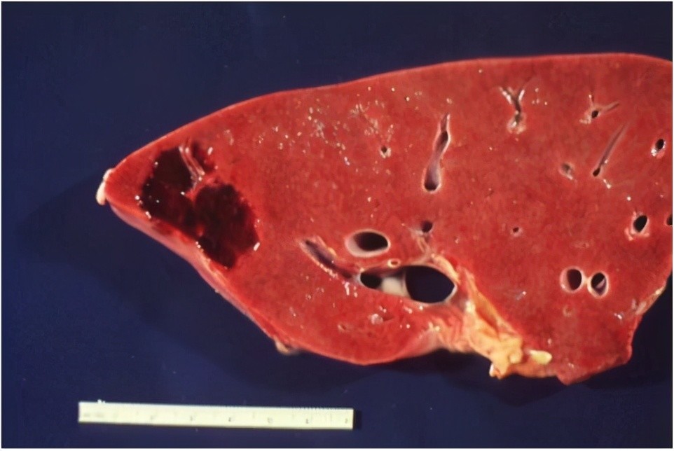发现肝血管瘤可以不用管吗这份肝血管瘤的自述看完你就懂了
