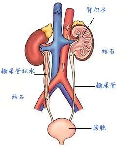 医生:这种情况及时就医|肾结石|肾脏|腰背痛