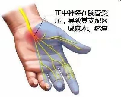 可视化让中医针刺不再神秘肌骨超声介入治疗腕管综合征