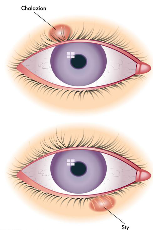 想要变身睫毛精种睫毛后睫毛根部竟生出螨虫