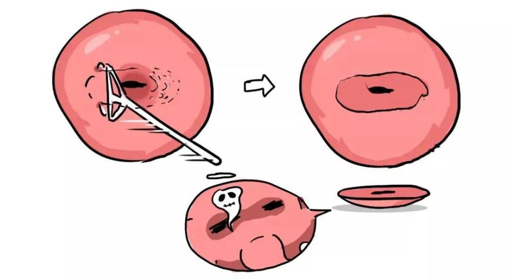 宫颈息肉可以影响受孕吗?_腾讯新闻