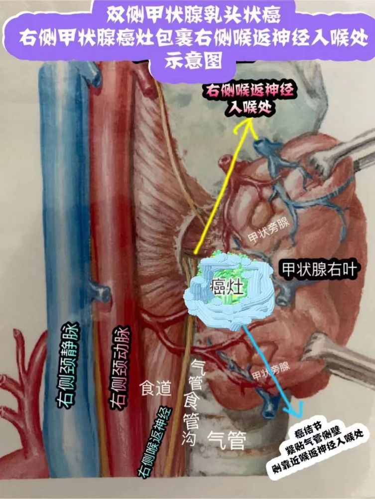 观察了3年的甲状腺结节最后不仅确诊双侧甲癌且侵犯喉返神经