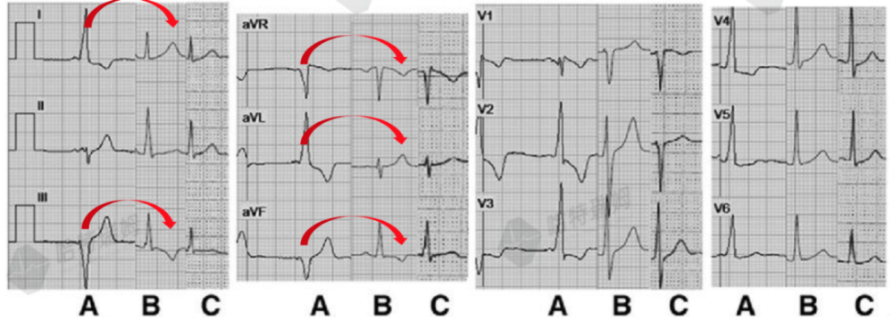 R波倒置图片