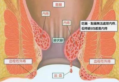 50%的人患有痔疮,疼痛加重就要注意了