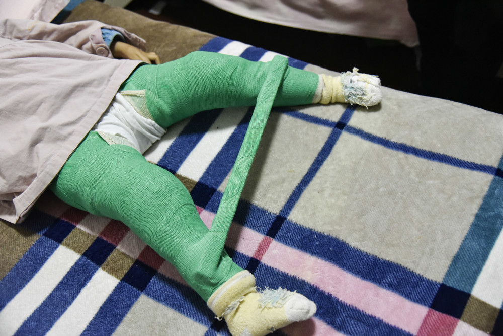 湖南一女孩出生时四肢畸形酷似青蛙,如今被钢架固定在床,无法动弹