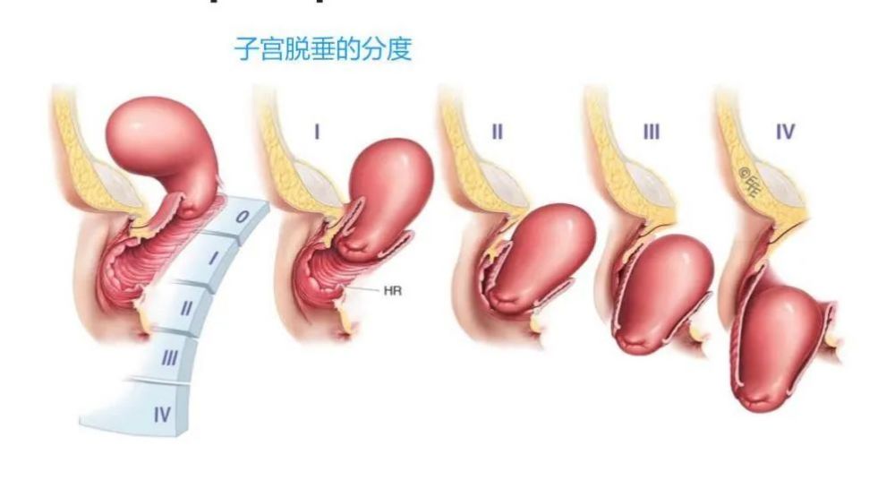 老年人严重子宫脱垂的治疗 腾讯新闻