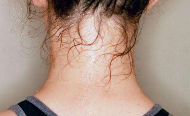 腋臭|如何在家就能轻松治疗腋臭？