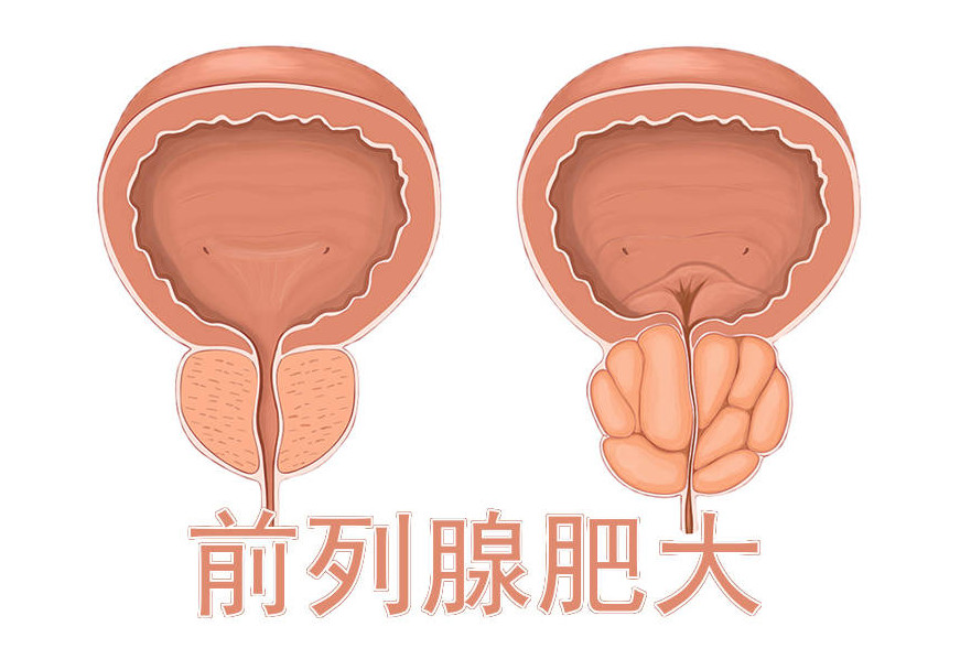 前列腺肥大会导致尿频,尿急,排尿困难,尿不尽和尿滴沥等问题,对男性