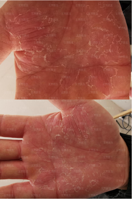 剥脱性角质松解症知识科普及案例分享