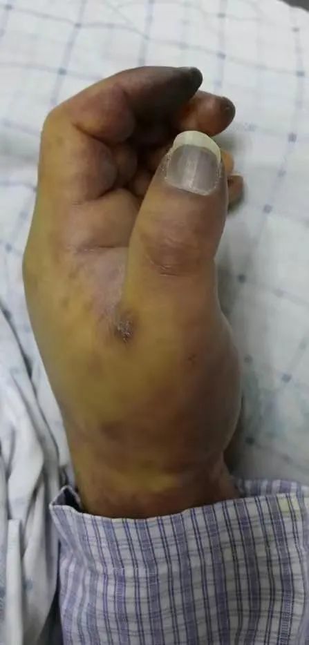 手指静脉血栓症状图图片