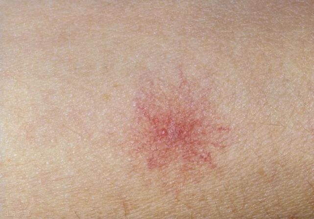 颈部及胸前大多表现为局部毛细血管扩张,自中心向四周呈放射状,形似