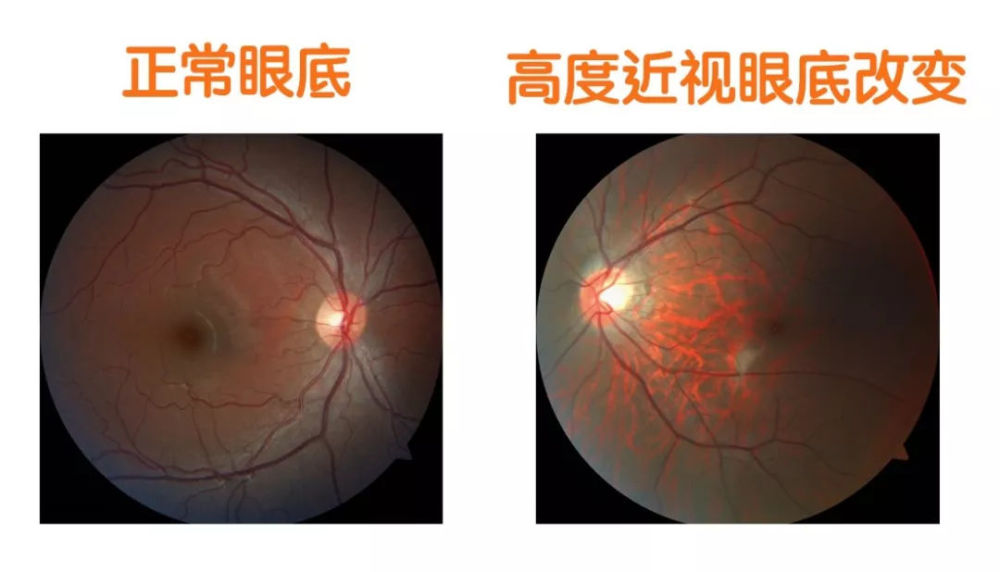 "科普"600度以上的高度近视者,小心失明的危险!