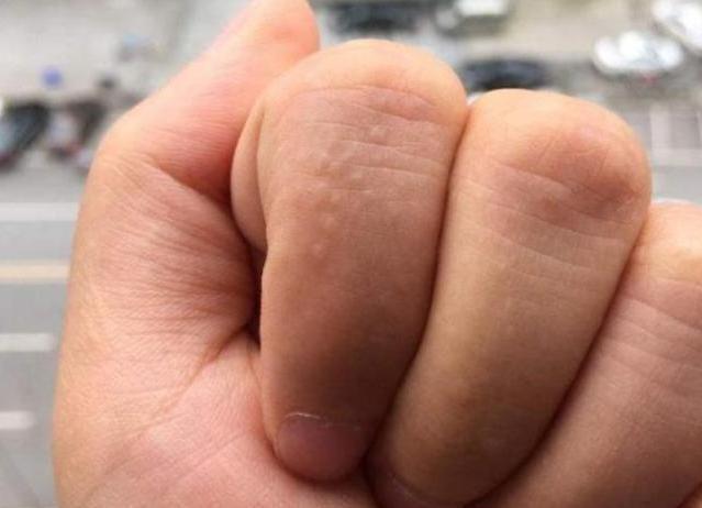 尿酸高的人能自查吗若手上有这3个现象提醒该注意了