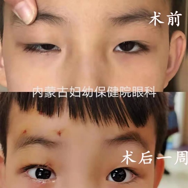 呼和浩特首例6岁上睑下垂患儿睁大了双眼