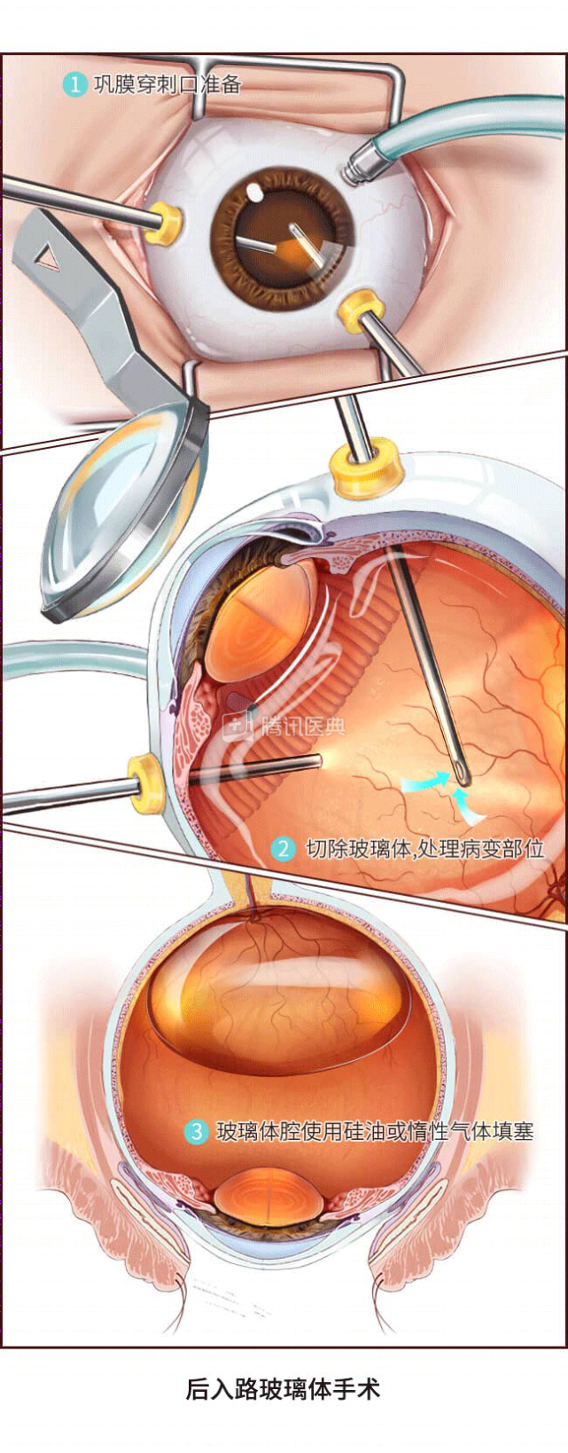 大家最关心的肯定是,视网膜脱离能不能治好.