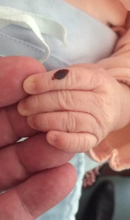 宝宝出生时手指被夹伤了,医生居然告诉我这是个胎记!