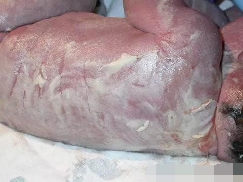 宝宝裹"奶油"出生,爸爸担心急哭,医生却说娃有福