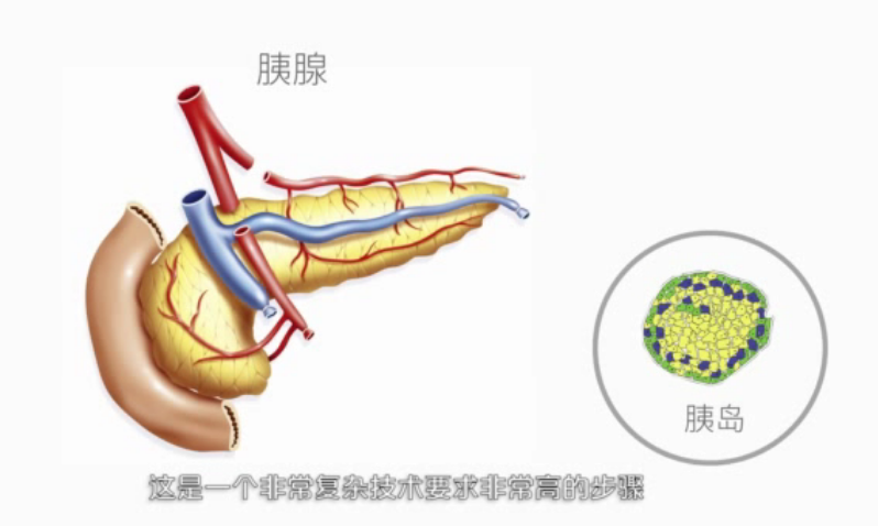 市第一中心医院器官移植中心细胞移植科主任王树森带您了解胰岛移植