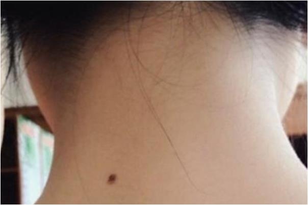 4颗"吉痣"在身,注定荣华富贵之命,得一颗可衣食无忧!