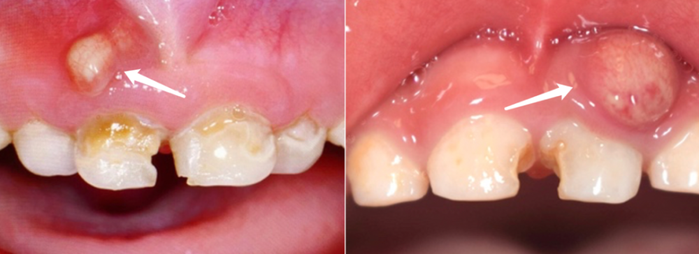 孩子牙龈长包吃点消炎药就能好吗