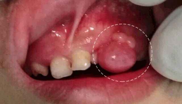 8岁儿童含牙囊肿图片
