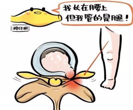 脚痛脚麻,是腰椎间盘突出?