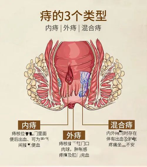 肛門處長了一個小肉球不痛不癢的是痔瘡嗎這問題需時刻警惕了