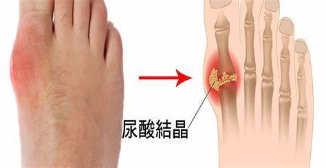 为什么老是让我痛风复查,不去可以吗?知道这三点让你放心复查.