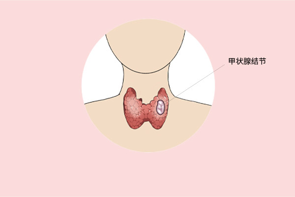 得了甲狀腺結節,海鮮一口不能吃?真正不宜吃的食物,列出來了