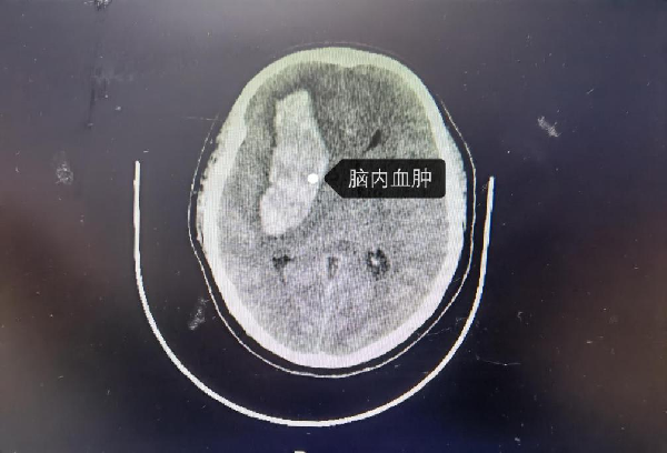 鄭州市一院生死營救4天4夜腦出血昏迷的患者終於轉危為安