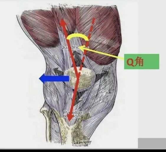 膝关节外翻,小腿外旋都会导致q角变大.