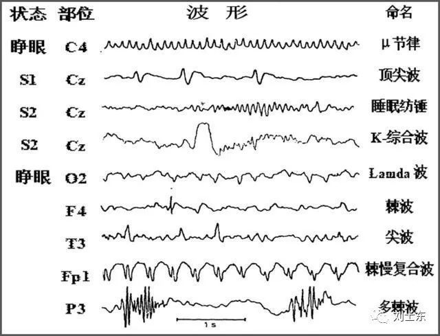 腦電圖基礎知識科普(簡單易懂)