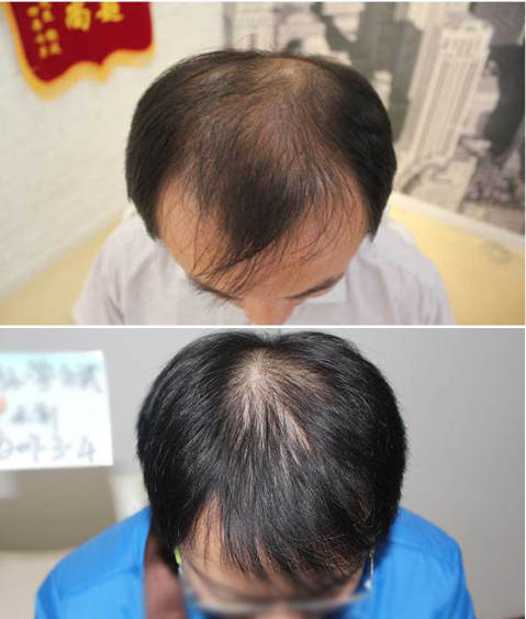 雄激素性脱发也称为男性型脱发