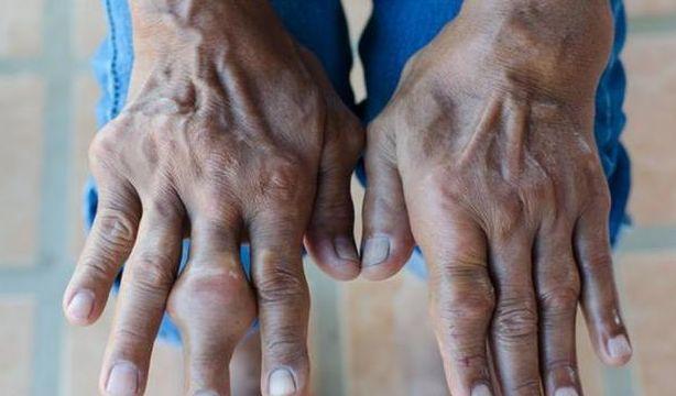 天然溶酸高手找到不想痛风敲门平时敞开喝尿酸悄悄降