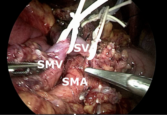 57岁胰腺癌患者新辅助化疗后成功完成全腹腔镜胰十二指肠切除_腾讯新