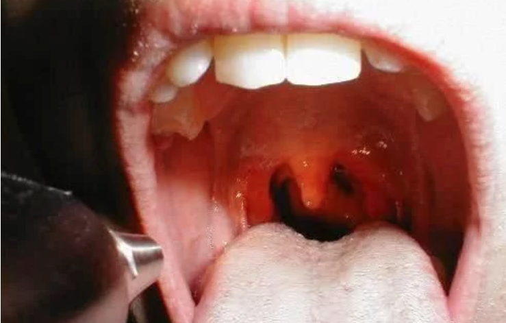 十有八九是咽喉炎:咽喉异物感与炎症刺激,或淋巴滤泡增生所引起的