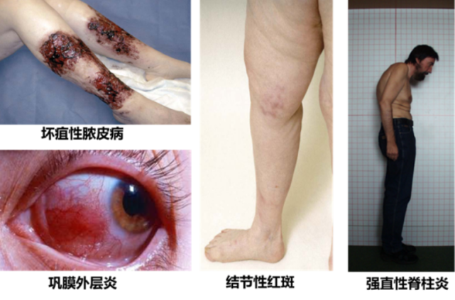 ibd伴肠外表现,如何选择生物制剂|坏疽性脓皮病|炎症性肠病|维得利珠