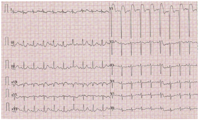病例丨右位心 急性心梗,这种技术不可少|急性心梗|心电图|高血压