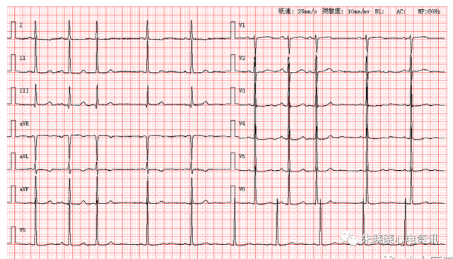 每日读图第1264期窦缓房早左心室高电压