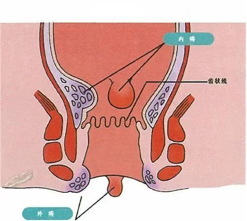 痔瘡手術後常反覆,做過都會後悔?不如每天一碗化痔湯