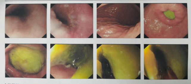 圖為術前胃鏡畫面sale圖為經胃切開十二指腸取出異物(竹筍)小編在這裡