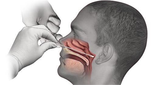 鼻咽拭子长度测量图片图片