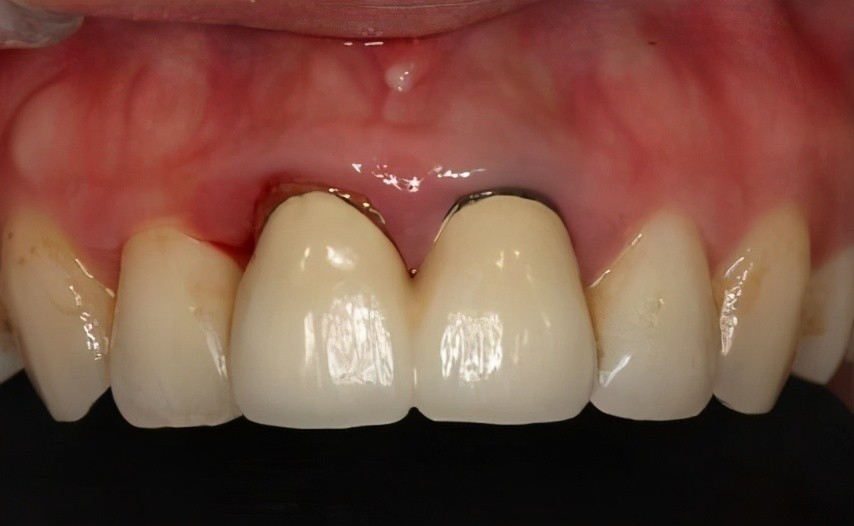 ""自从戴上烤瓷牙冠,经常牙龈红肿流血"